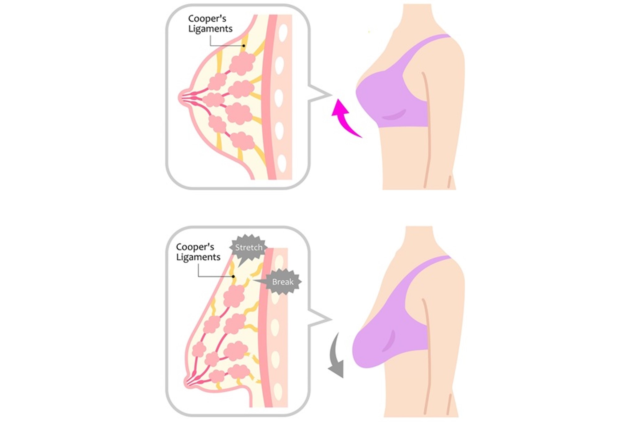 Sagging Old Tits: Causes, Support, and What to Expect