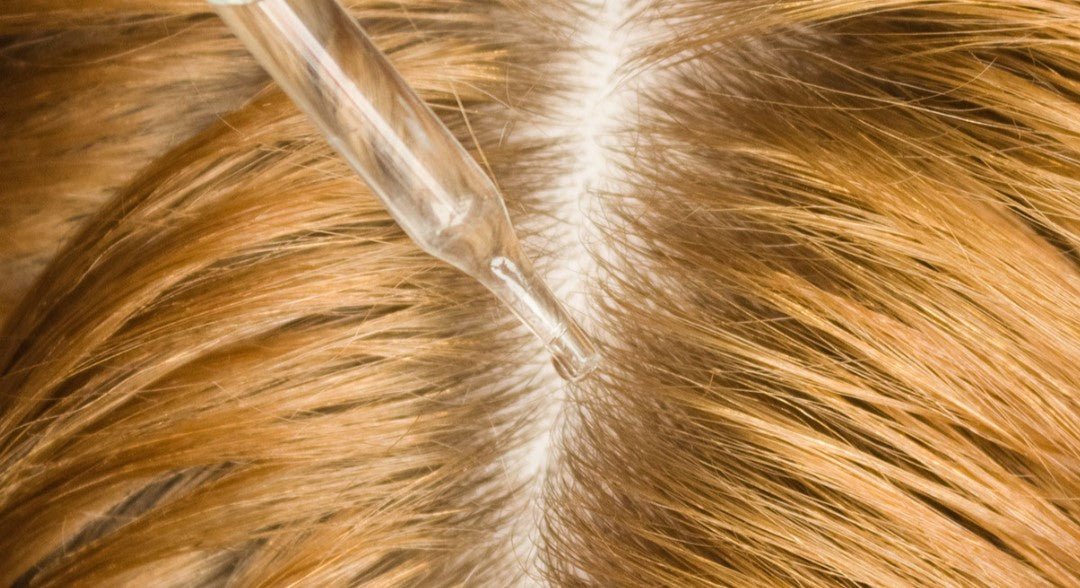 Top Methods to Reduce Scalp Inflammation and Promote Healthy Hair