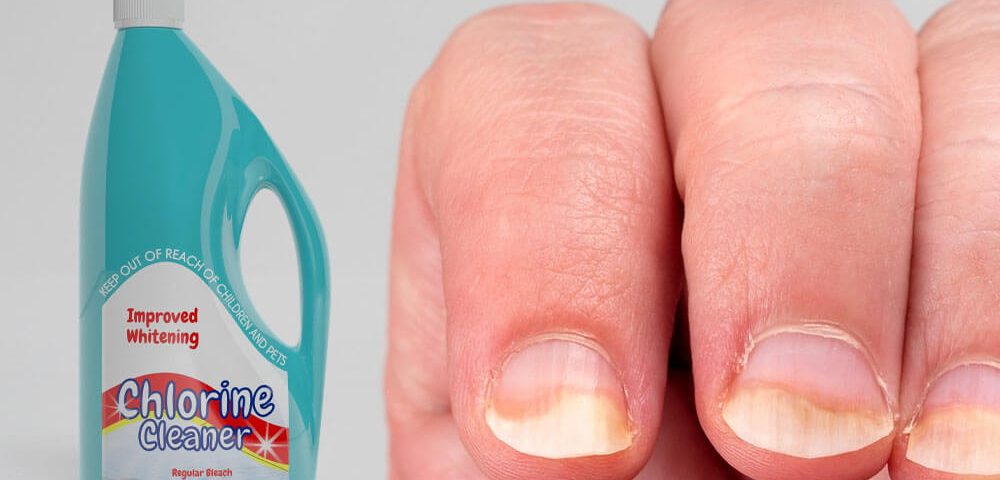 Does Bleach Kill Toenail Fungus? Risks and Alternatives You Need to Know