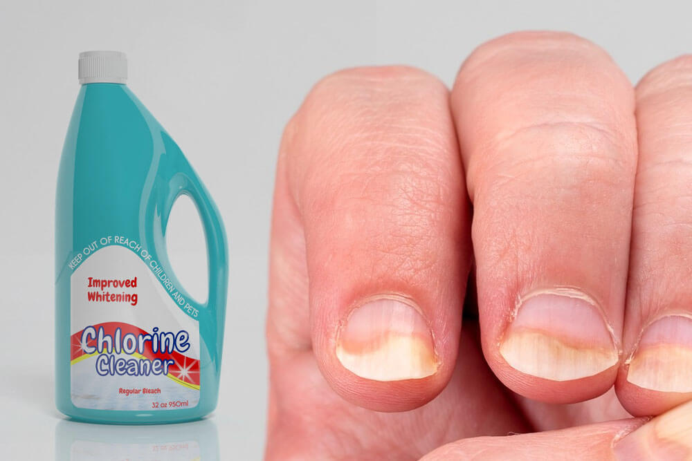 Can Bleach Effectively Treat Nail Fungus? Safer Alternatives Explained