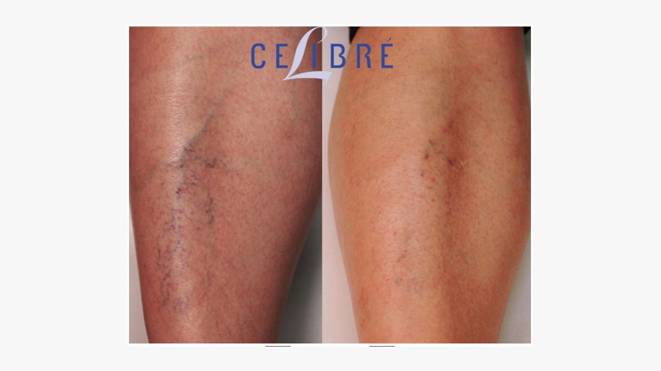 Before and After Using Witch Hazel for Spider Veins: Real Transformation