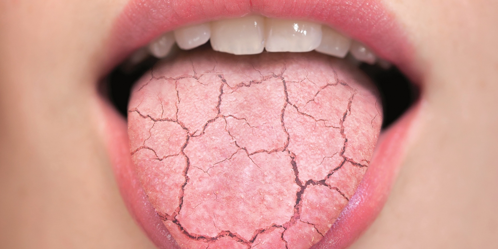 Xerostomia in COVID-19 Patients: What You Need to Know About Dry Mouth