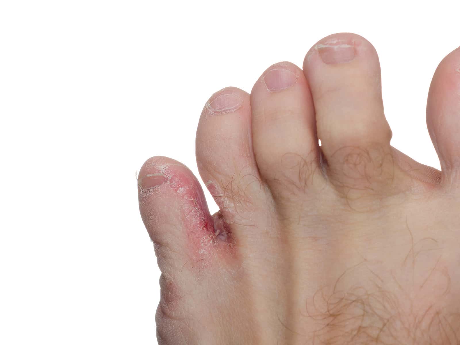 Can Bleach Cure Athletes Foot? Expert Insights on Treatment