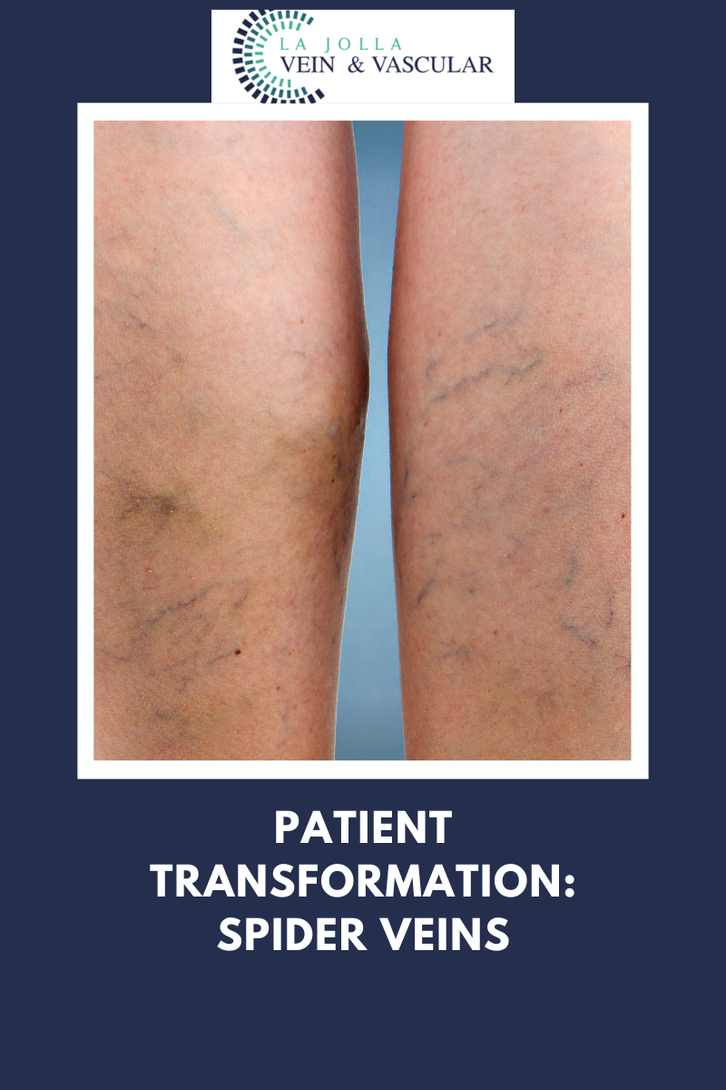 Before and After Using Witch Hazel for Spider Veins: Real Transformation