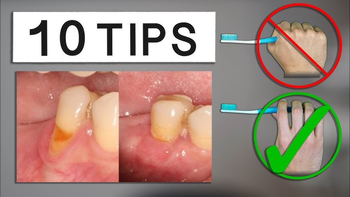 How to Brush Teeth with Receding Gums: Tips and Tricks