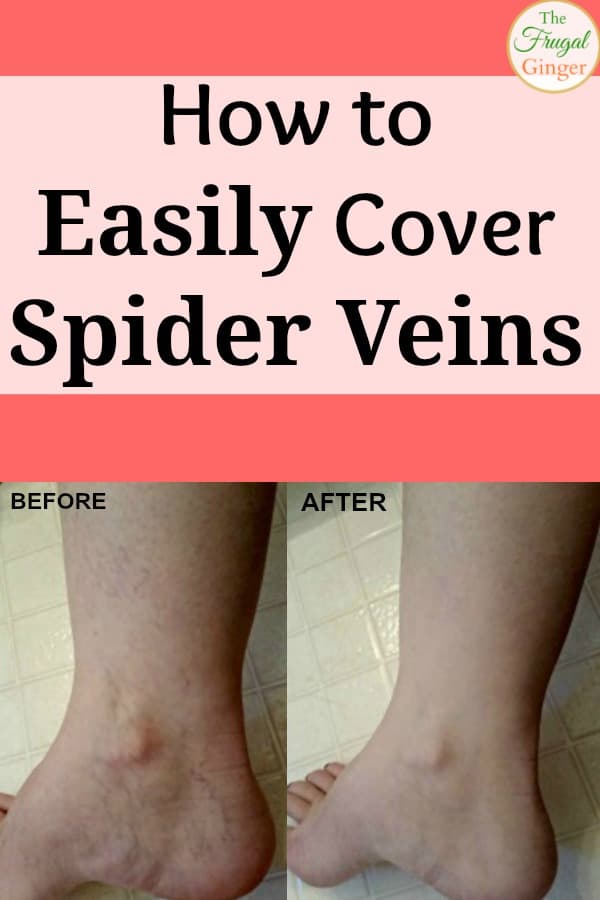 Best Ways to Camouflage Spider Veins on Your Legs