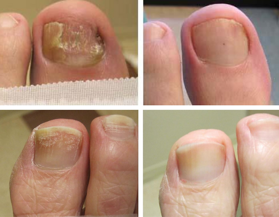 Does Bleach on Toenails Really Work? The Truth Revealed