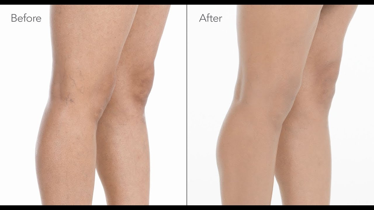 Best Ways to Camouflage Spider Veins on Your Legs