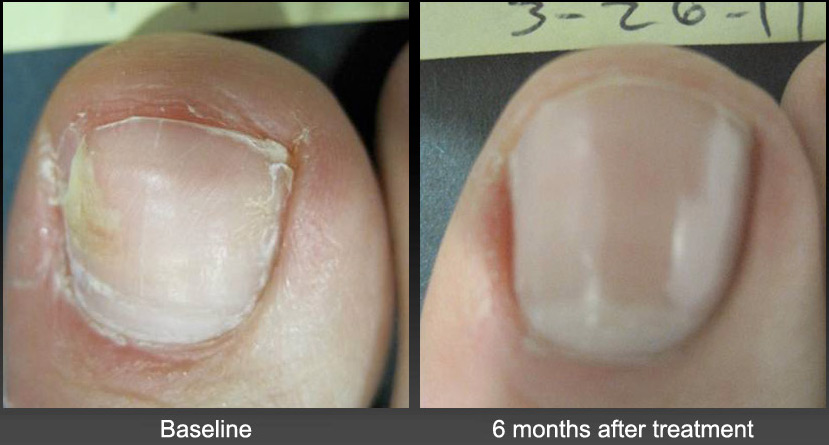 How to Use Ultraviolet Light for Toenail Fungus: A Simple Guide