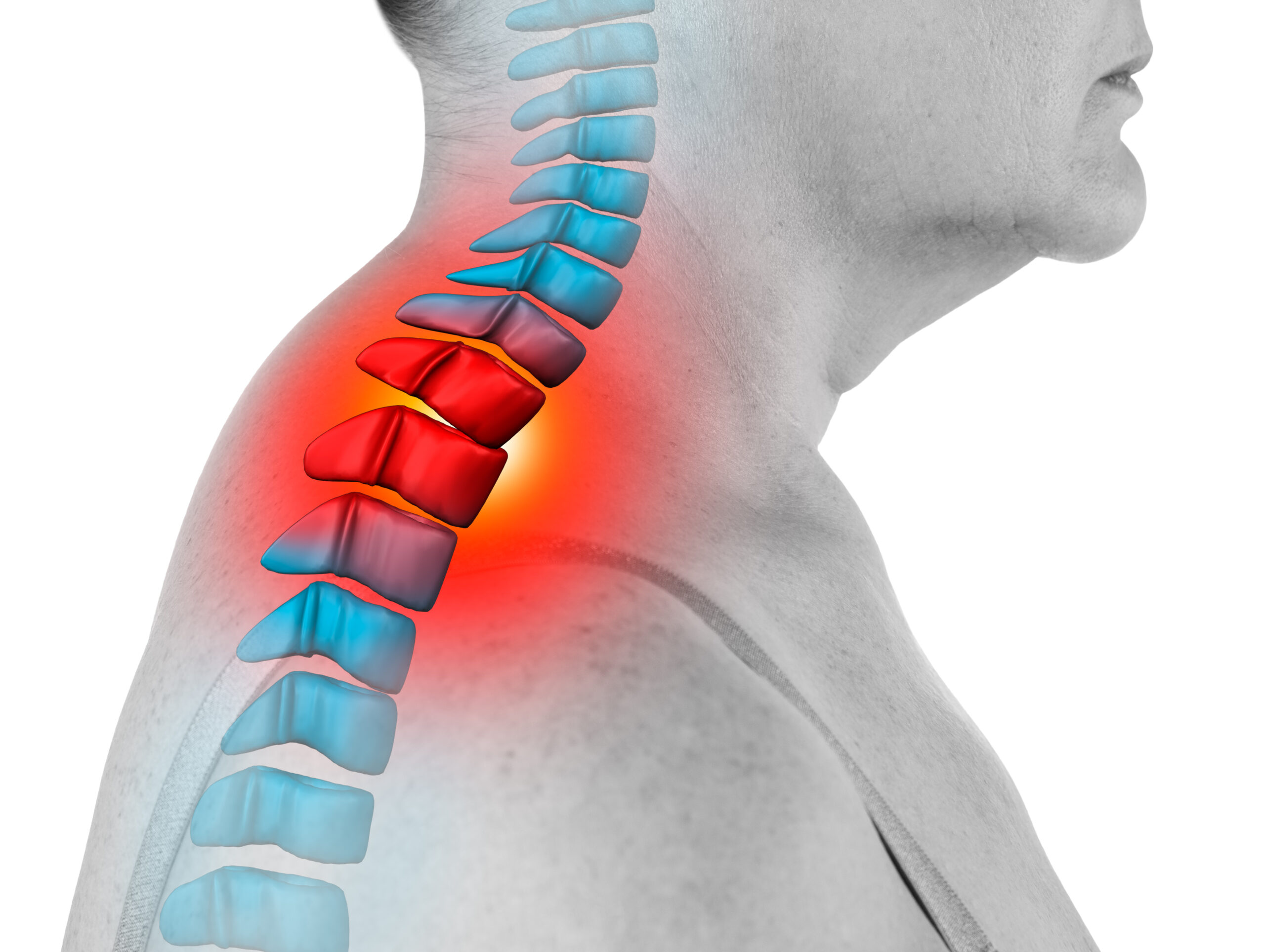 Struggling with Neck Hump? A Chiropractor for Neck Hump Can Help