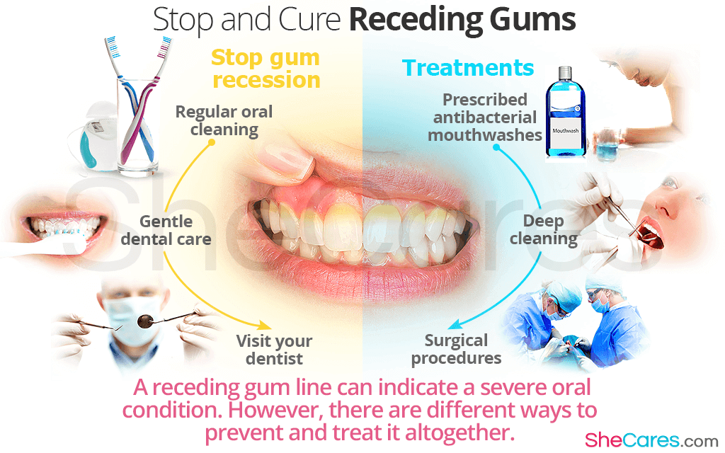 How to Brush Teeth with Receding Gums: Tips and Tricks