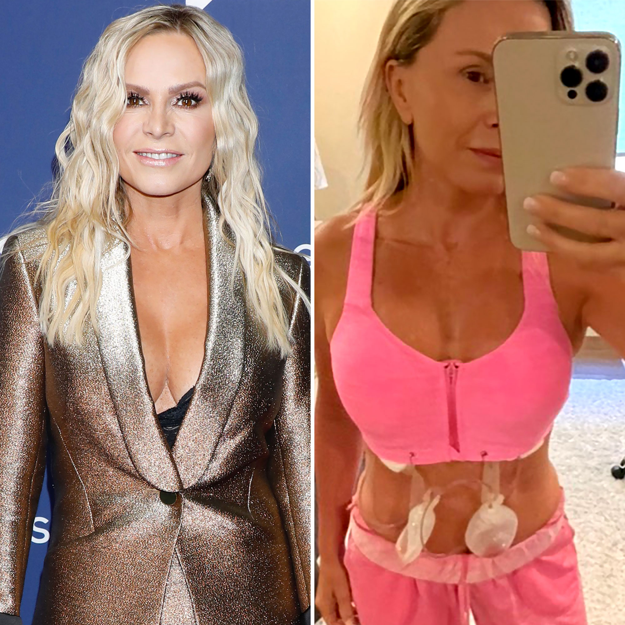 Celebrity Tummy Tucks Before and After: Who Had the Best Work?