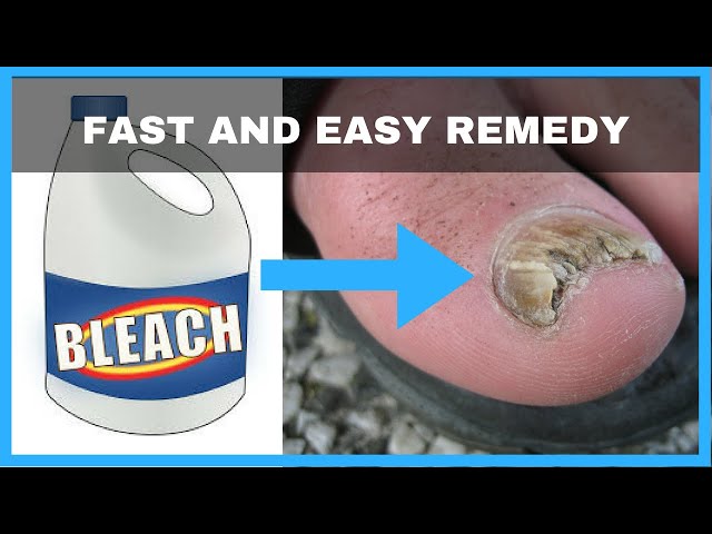 How to Use Bleach Soak for Toenail Fungus Safely