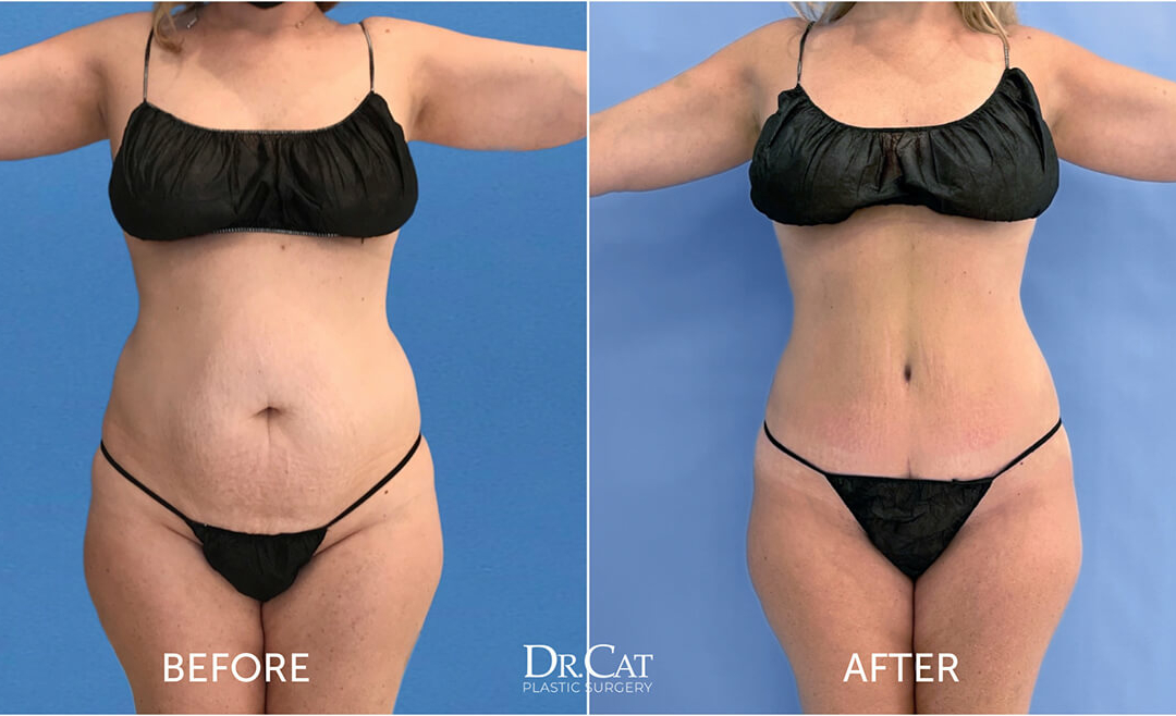 Dealing with a Celebrity Tummy Tuck Scar: Tips and Tricks