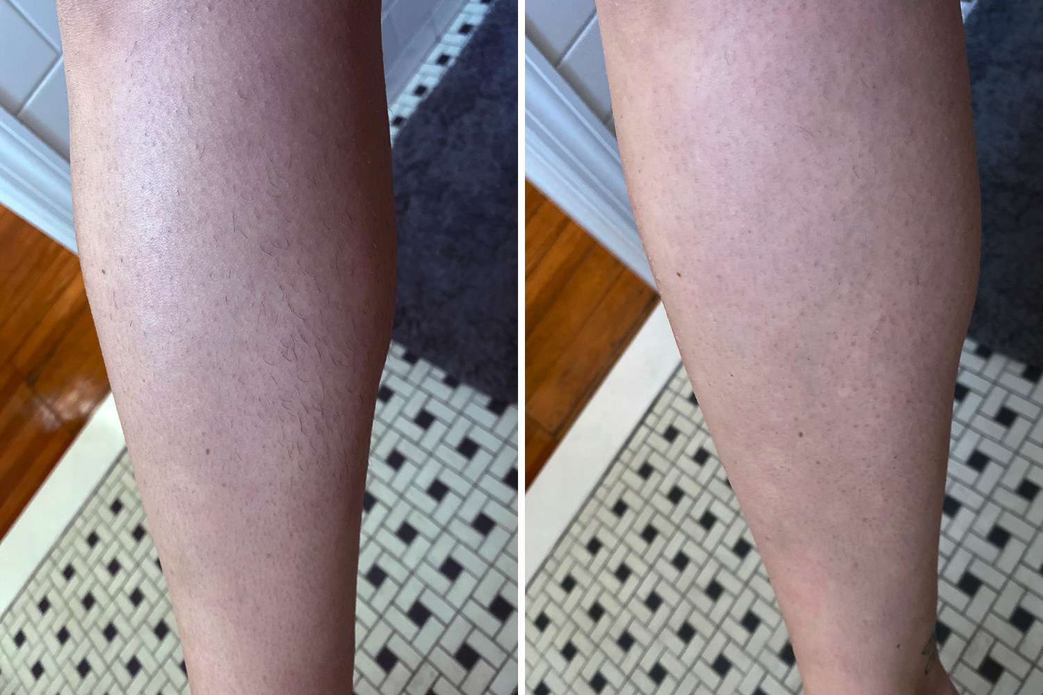 Does Epilation Really Work? Epilator Before After Review